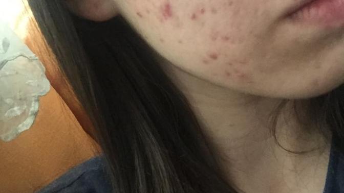 Benim yüzümdekileri roaccutane geçirir mi?