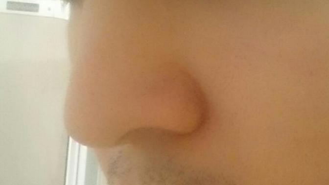Burun ucum düştü ne yapmam lazım?/fotoğraflı?