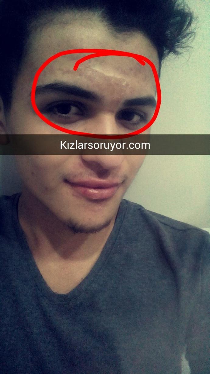 ZORETANİN' KULLANIYODUM AĞDA YAPINCA KABARDI LEKE KALDI NE YAPMAM GEREK ?