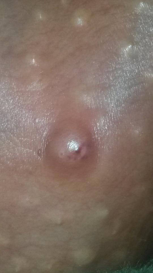 Bune arkadaşlar sivilce mi çıban mi baska bisey mi ?