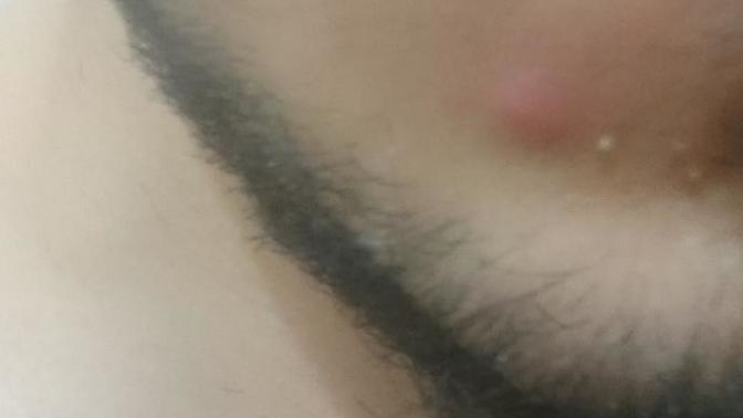 Yüzümdeki sivilceyi yara bandı ile kapatayım mı?(Fotoğraflı)?