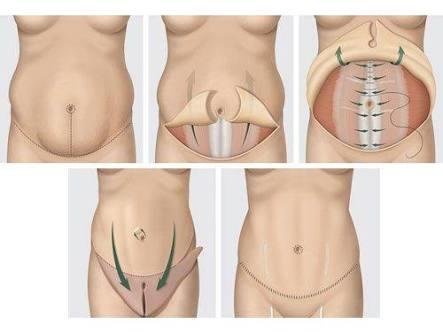Sporcular bir bakabilir mi? ekstrem zayıflamalarda sarkan bedenin toparlanması için gerekenler?