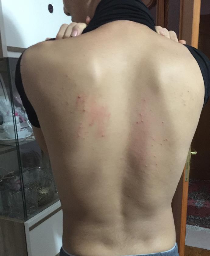 Sırtımda bir anda sivilceler çıktı ?