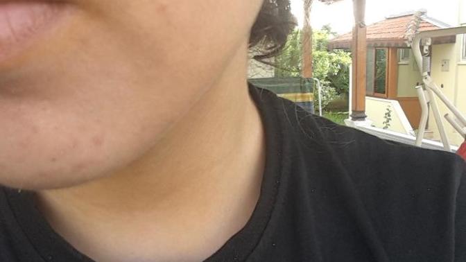 Akne ve sivilce arasındaki fark nedir? Bu akne midir sivilce mi?(Resimli)?