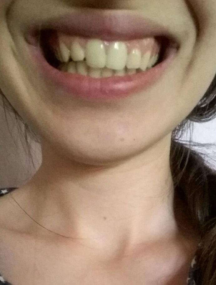 Dişlerime ne gibi işlemler gerekli?