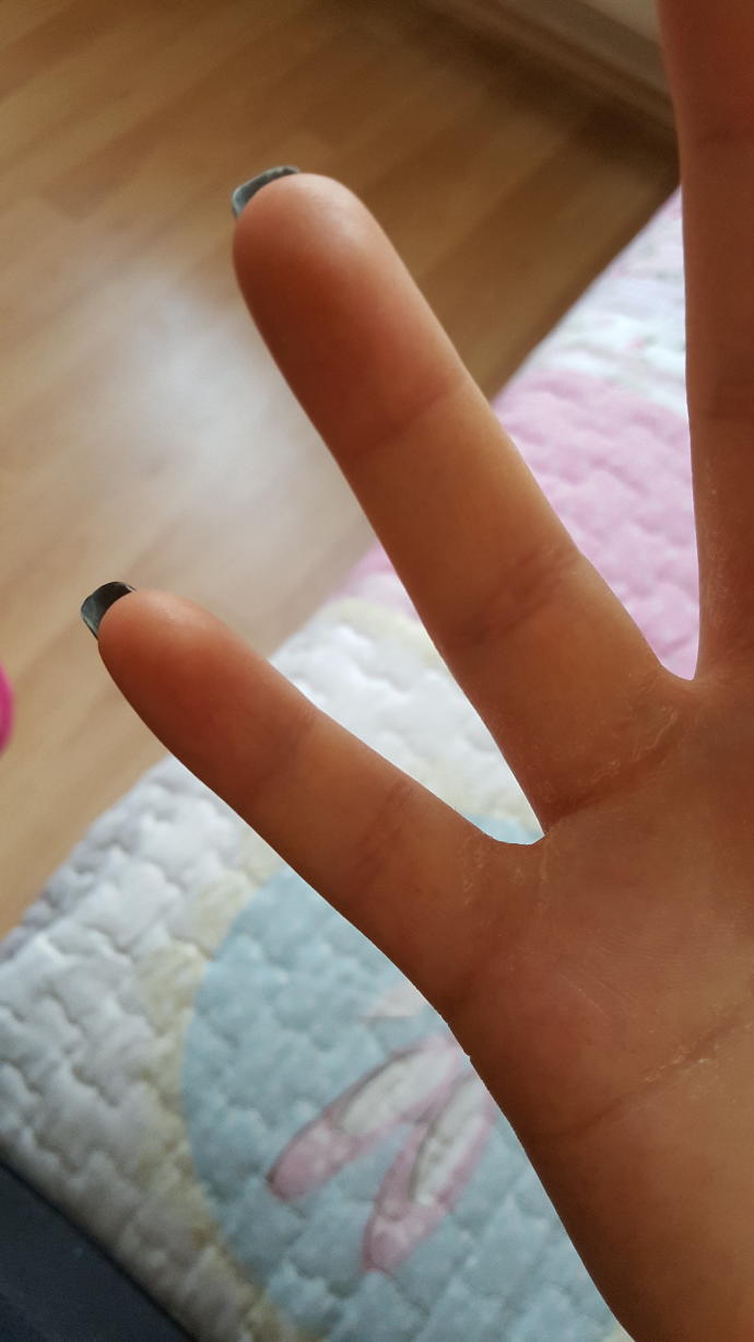 Ellerimin içi neden soyuluyor (Fotoğraflı)?