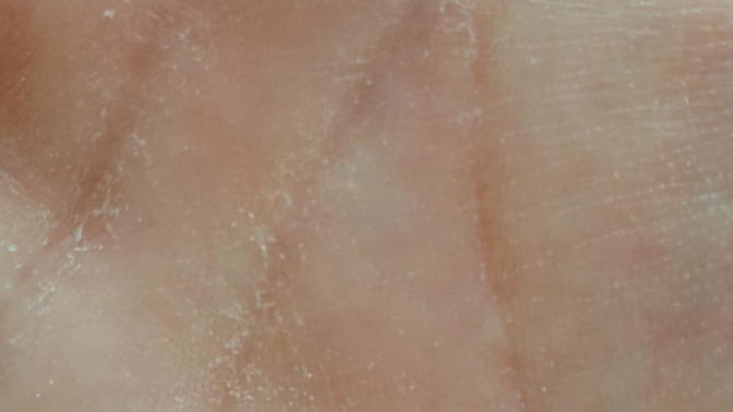 Ellerimin içi neden soyuluyor (Fotoğraflı)?