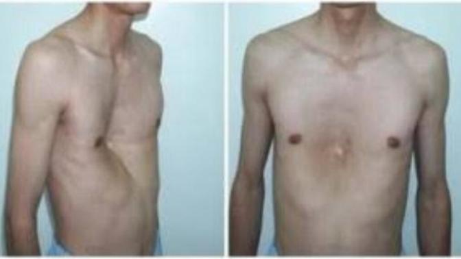 Güvercin göğsü nedir?