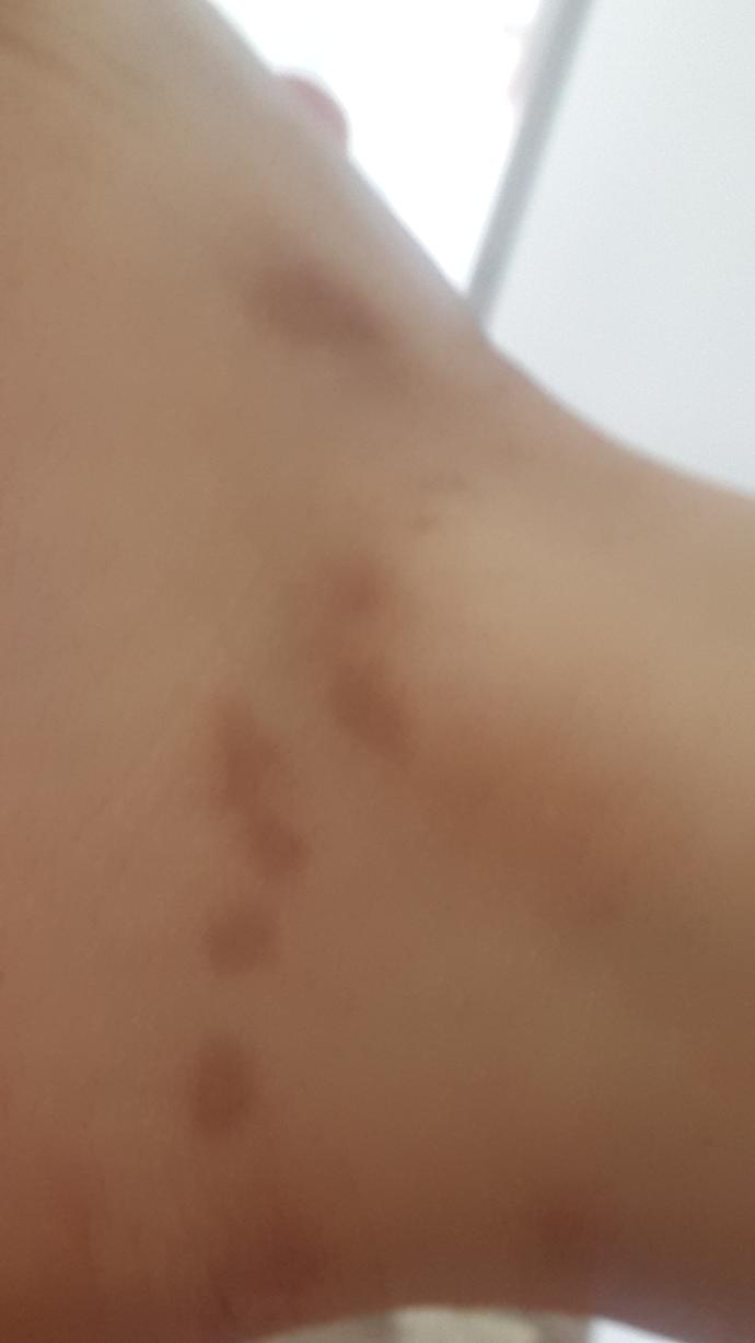 Bacaklarımda yara izleri kalıyor estetik mi olmalıyım?