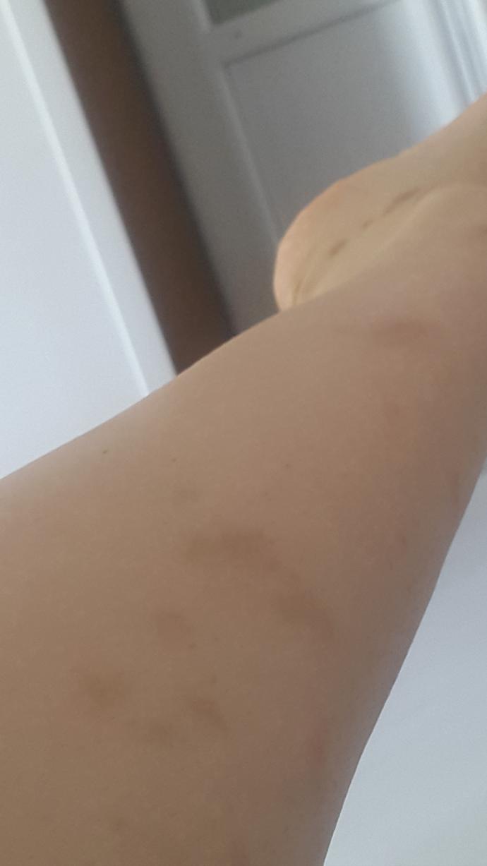 Bacaklarımda yara izleri kalıyor estetik mi olmalıyım?