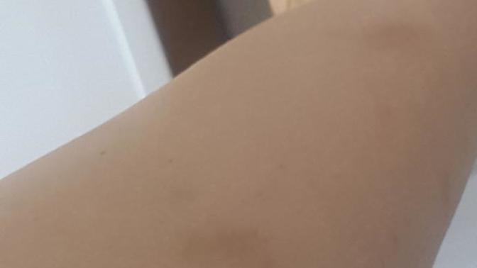 Bacaklarımda yara izleri kalıyor estetik mi olmalıyım?
