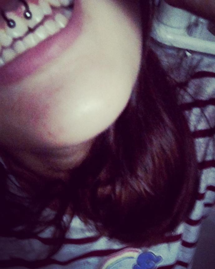 Smiley piercingimi çıkaramıyorum?