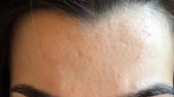 Arkadaşlar alnımda çok fazla sivilce izi kaldı, roaccutane kullansam geçebilir mi? Fotoğraf paylaşıyorum ya çok mu kötü?