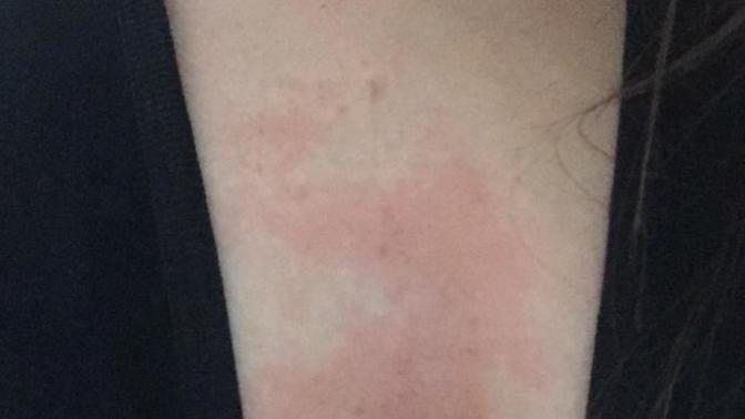 Lazer Epilasyon Sonrası Vücudum Bu Hale Geldi, Geçer mi?