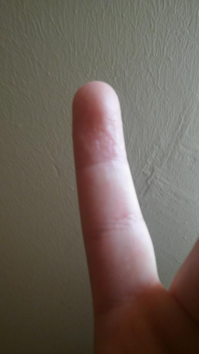 Elimde kucuk kucuk kabarciklar var lutfen yardim ?