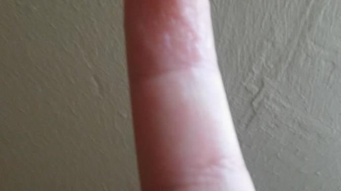 Elimde kucuk kucuk kabarciklar var lutfen yardim?