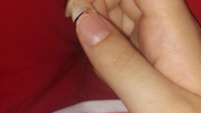 Tırnağım çok kötü kırıldı ne yapabilirim? Resimli.  bir  bakarmisiniz?