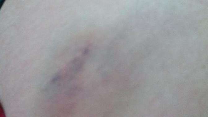 Dün iğne oldum morarma oldu?