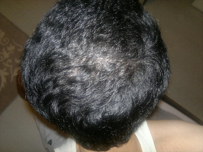 (Resimli) yaş 19 kel mi olucam ilerde yoksa sadece alnım mı geniş sizce?