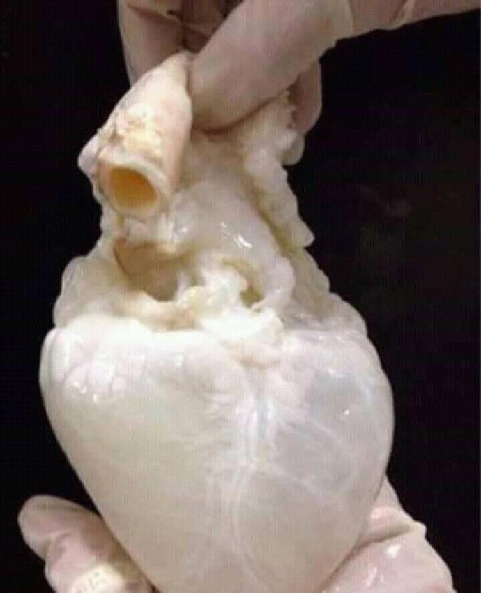 Kanı temizlenmiş kalp gördünüz mü hiç?