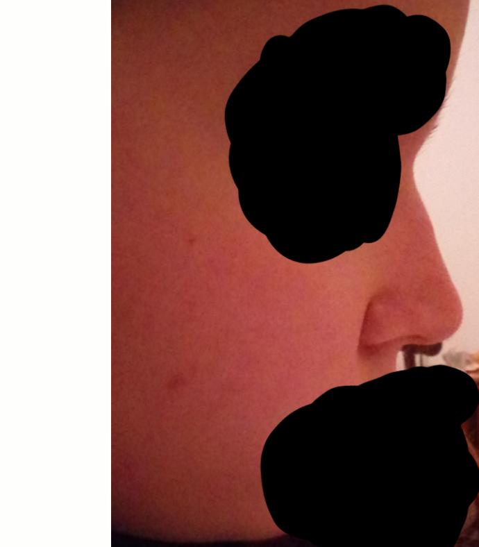 Burnuma estetik yaptircam sizce kusurlari neler acimasiz olun ama cok abartmadan? 