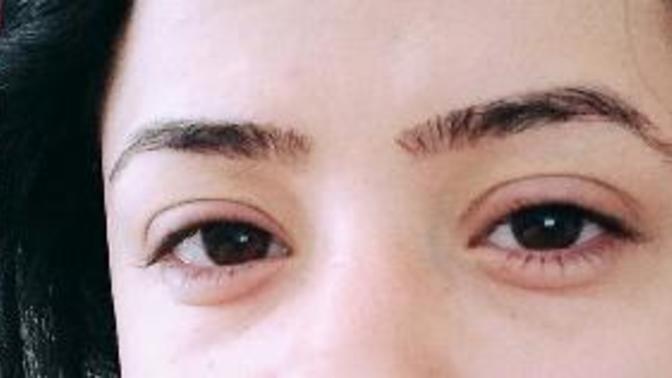 Ağlamaktan şişen gözler için ne yapmalıyım (resimli)?