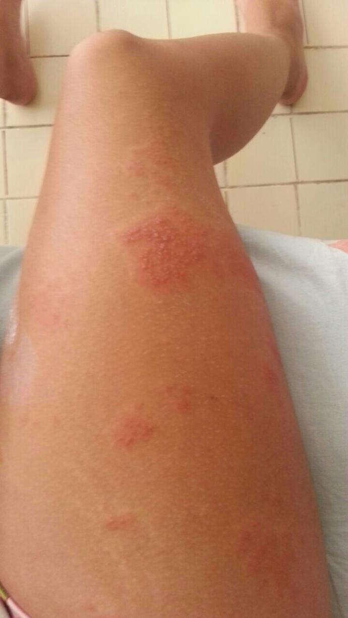 Doktora gittim alerji dedi krem verdi kullaniyorum iki gundur gecmiyor sinirlerim bozuluyor napmam gerek yasayan var mi?