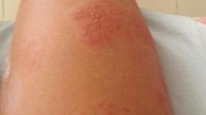 Doktora gittim alerji dedi krem verdi kullaniyorum iki gundur gecmiyor sinirlerim bozuluyor napmam gerek yasayan var mi?