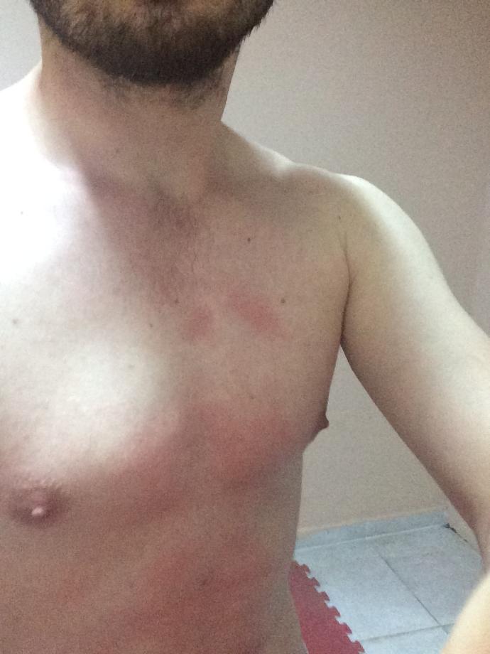 Fitness yaptıktan sonra niye kızarıyor göğsün karnım?