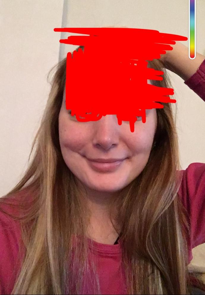 sağ yanağım yamuk (Foto) ne yapabilirim psikolojimi bozuyor :( ?