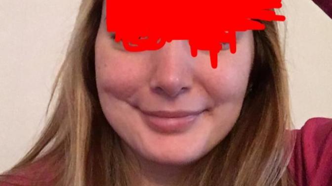 Sağ yanağım yamuk (Foto) ne yapabilirim psikolojimi bozuyor :( ?