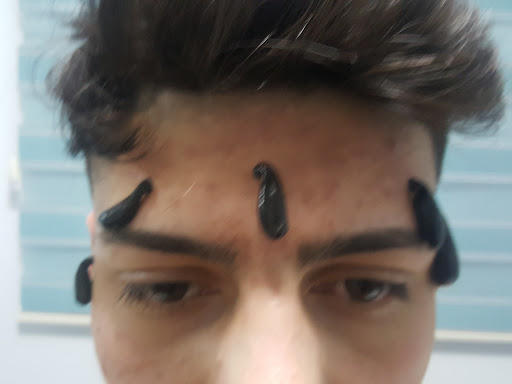 Sivilce için Sülük Tedavisi Yaptıranlar? İyi Gelir mi?