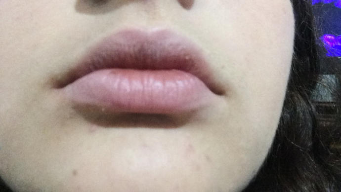 Dudak dolgum nasıl olmuş?