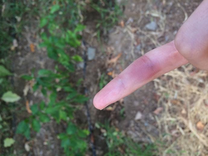 Parmağımda önce sertlik sonra kendiliğinden morarmalar?