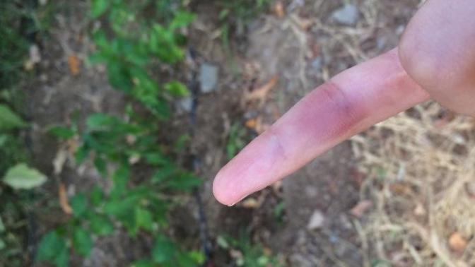 Parmağımda önce sertlik sonra kendiliğinden morarmalar?
