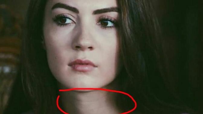 Boyundaki bu çizgiler neden olur (resimli) ?