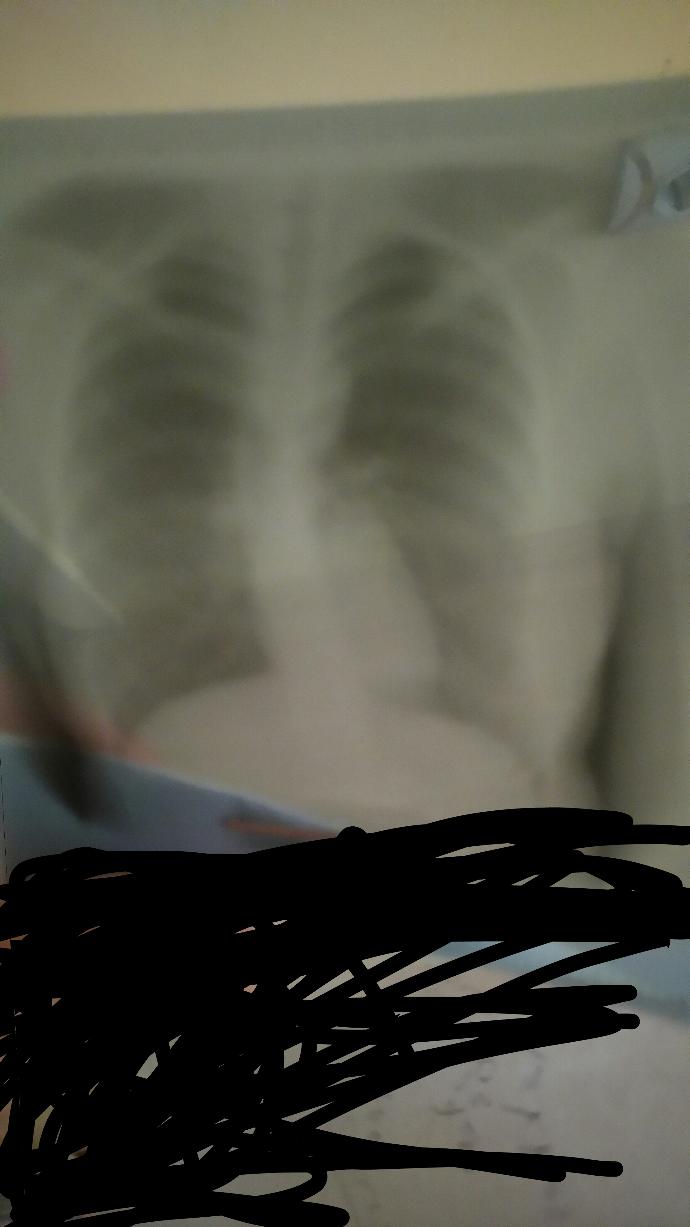 Akciğerimde bir hastalık mı var lütfen anlayanlar bakabilir mi?