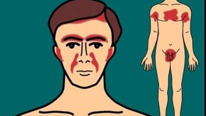 Seboreik dermatit nasıl tedavi edilir (başıma gelmez demeyin gelebilir)?