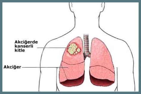 Akcigerde kitle iyi huylu/kotu huylu cikarsa ne gibi etkileri olur?  bir  bilgisi olan varsa cok acil yazabilir mi??