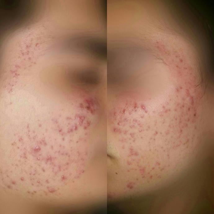 Sivilce geçirmek için hap kullanan var mı ?