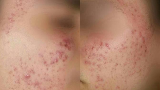 Sivilce geçirmek için hap kullanan var mı?
