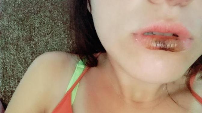 Dudak uçuklaması için doğal geçirme yöntemi var mı?