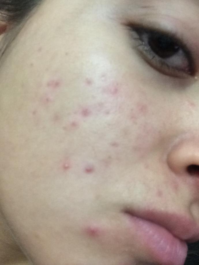 Roaccutane Kullanmalı Mıyım ?