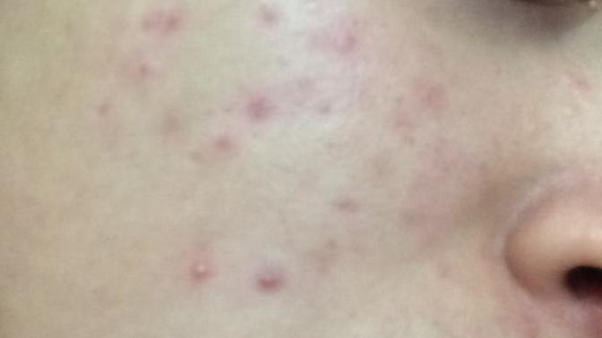 Roaccutane Kullanmalı Mıyım?
