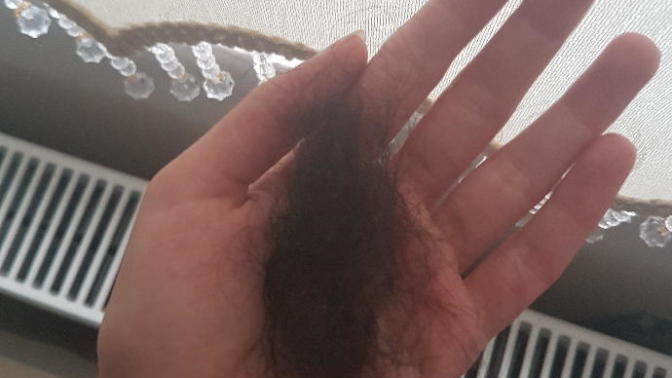 Her gün bu kadar Saç dökülmesi normal mi?