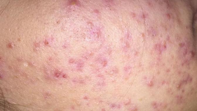 Sizce bu akne mi akne izi mi?