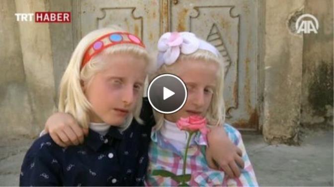 Çocuğum albino hastası doğdu?
