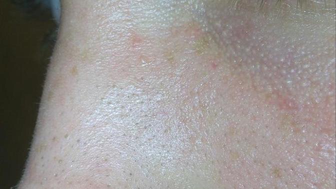Kafayı yedim burnumdaki siyah noktalar nasıl iyileşir burun bandı demeyin kullanmam. RESİMLİ?