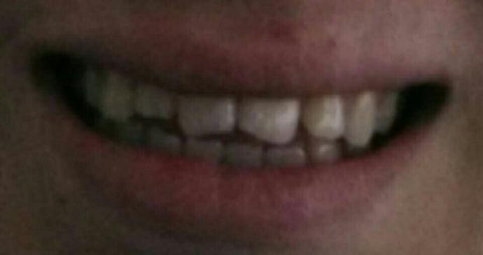 Resim çekilirken gülemiyorum dişlerim çok kötü?