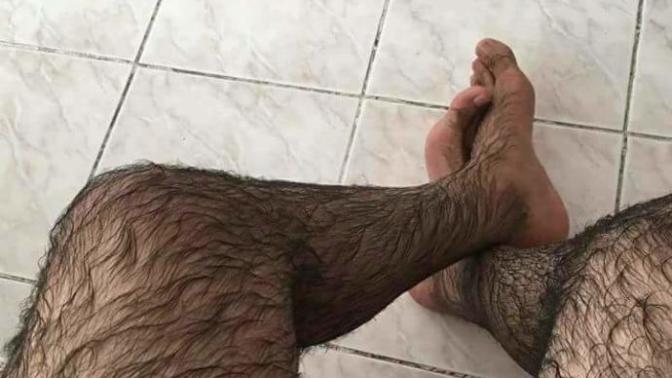 Arkadaşlar bacaklarım çok kıllı çözümü nedir?